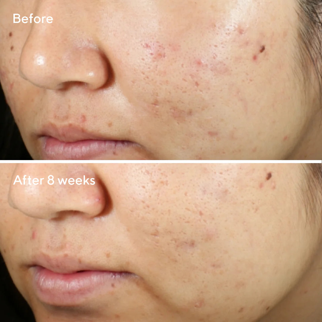 Murad Sale. Murad CLEARANCE SALE. Murad Invisiscar Resurfacing Treatment is for anyone wanting to reduce the appearance of post blemish, pimple and acne prone scarring. Reduces the appearance of scarring in 8 weeks