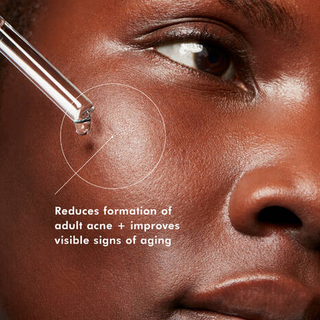 SkinCeuticals Blemish and Age Defense Salicylic Acid Serum is a targeted, oil-free approach for ageing skin prone to breakouts. This acid blend combines 2% dioic acid with an optimal alpha- and beta-hydroxy acid formulation to reduce the formation of blemishes and clogged pores, while improving the appearance of fine lines, wrinkles, and uneven skin tone.