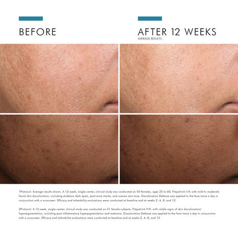 SkinCeuticals Discolouration Defense Dark Spot Serum is a layer-able, daily-use dark spot corrector clinically proven to reduce the appearance of key types of skin discolouration in all skin tones, including hard-to-treat forms such as hyperpigmentation.
Formulated with 3% tranexamic acid, 1% kojic acid, 5% niacinamide, and 5% HEPES, this formula serum for dark spots improves the appearance of skin discolouration, brightens skin, and evens skin tone in as early as 2 weeks.