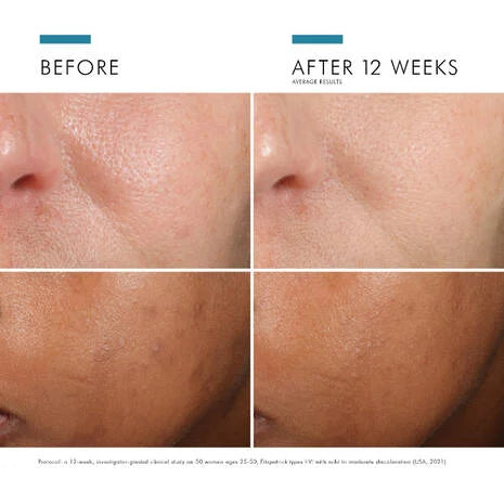 SkinCeuticals Phloretin CF Vitamin C Serum contains an array of skincare ingredients that all work in combination to deliver exceptional results.
The ingredients, including 2% phloretin, 10% pure vitamin C (L-ascorbic acid), and 0.5% ferulic acid are proven to target atmospheric ageing, visibly reduce environmental damage to skin and premature signs of ageing.