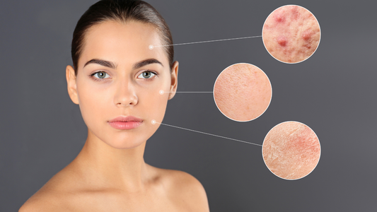 Dry skin vs dehydrated skin skincare advice from Skin Deep Medispa for sensitive, dry and acne-prone skin.