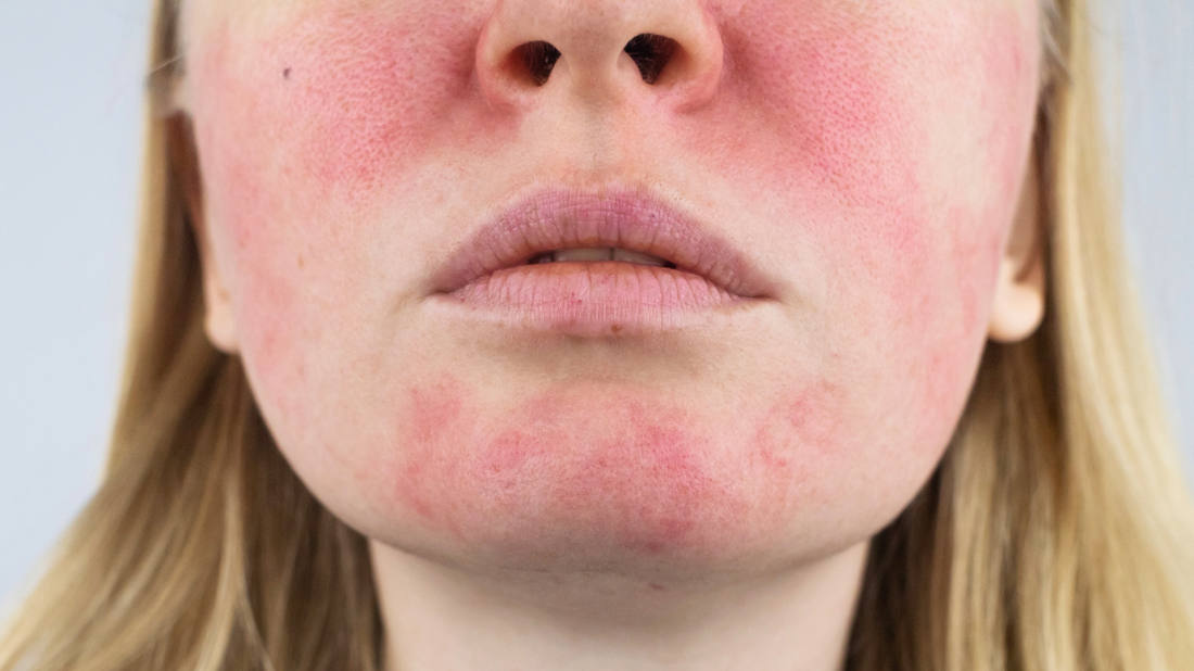 What Is A Damaged Skin Barrier? Signs Your Skin Needs Repair