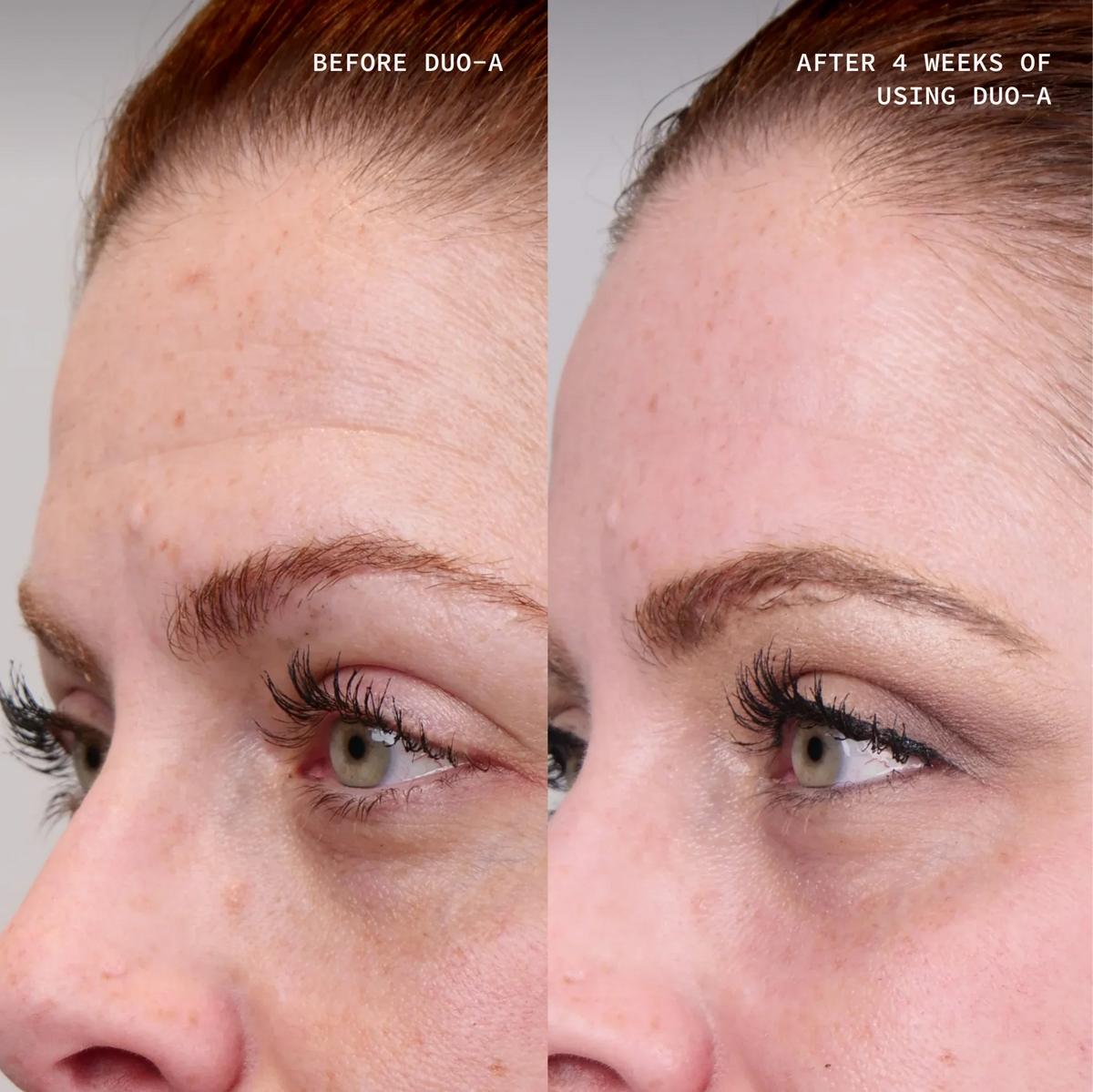 Cosmedix Elite Duo-A results showing visibly smoother, more even-looking skin after four weeks.