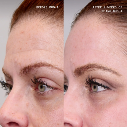 Cosmedix Elite Duo-A results showing visibly smoother, more even-looking skin after four weeks.