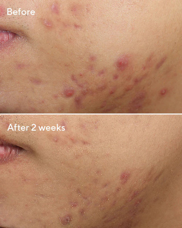Murad Sale. Murad 15% off. Murad Deep Relief Blemish Treatment is for oily, combination, sensitive, balanced and acne prone skin.
