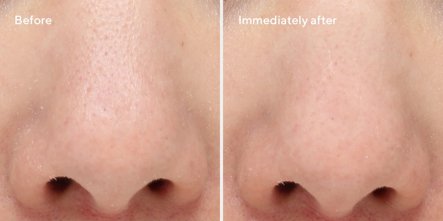 Targeted Pore Corrector is for oily, combination, sensitive, balanced and acne prone skin. and for anyone wanting to reduce the appearance of enlarged pores.