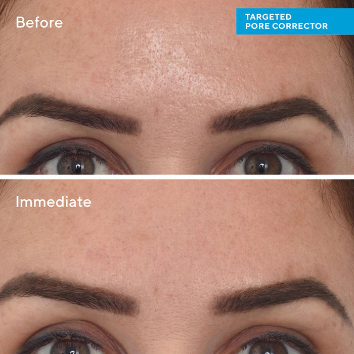 Targeted Pore Corrector is for oily, combination, sensitive, balanced and acne prone skin. and for anyone wanting to reduce the appearance of enlarged pores.