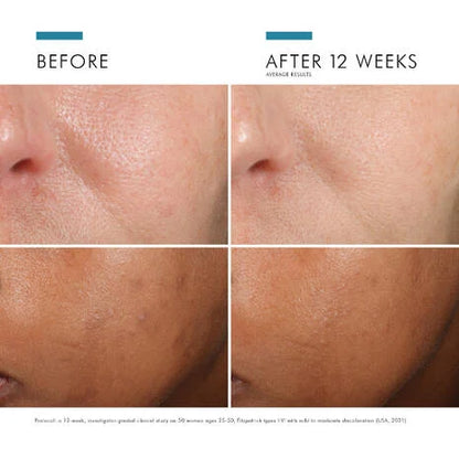 SkinCeuticals Phloretin CF before and after image showing visible improvement in skin tone and discolouration with continued use.