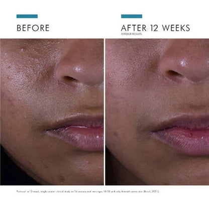 SkinCeuticals Silymarin CF before and after image showing visible improvement in skin clarity and overall complexion with continued use.