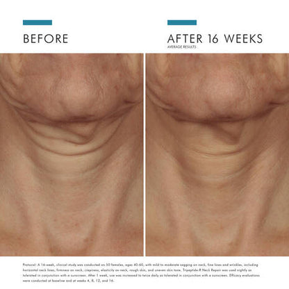 SkinCeuticals Tripeptide-R Neck Repair before and after image showing visible improvement in neck texture and crepiness after continued use.