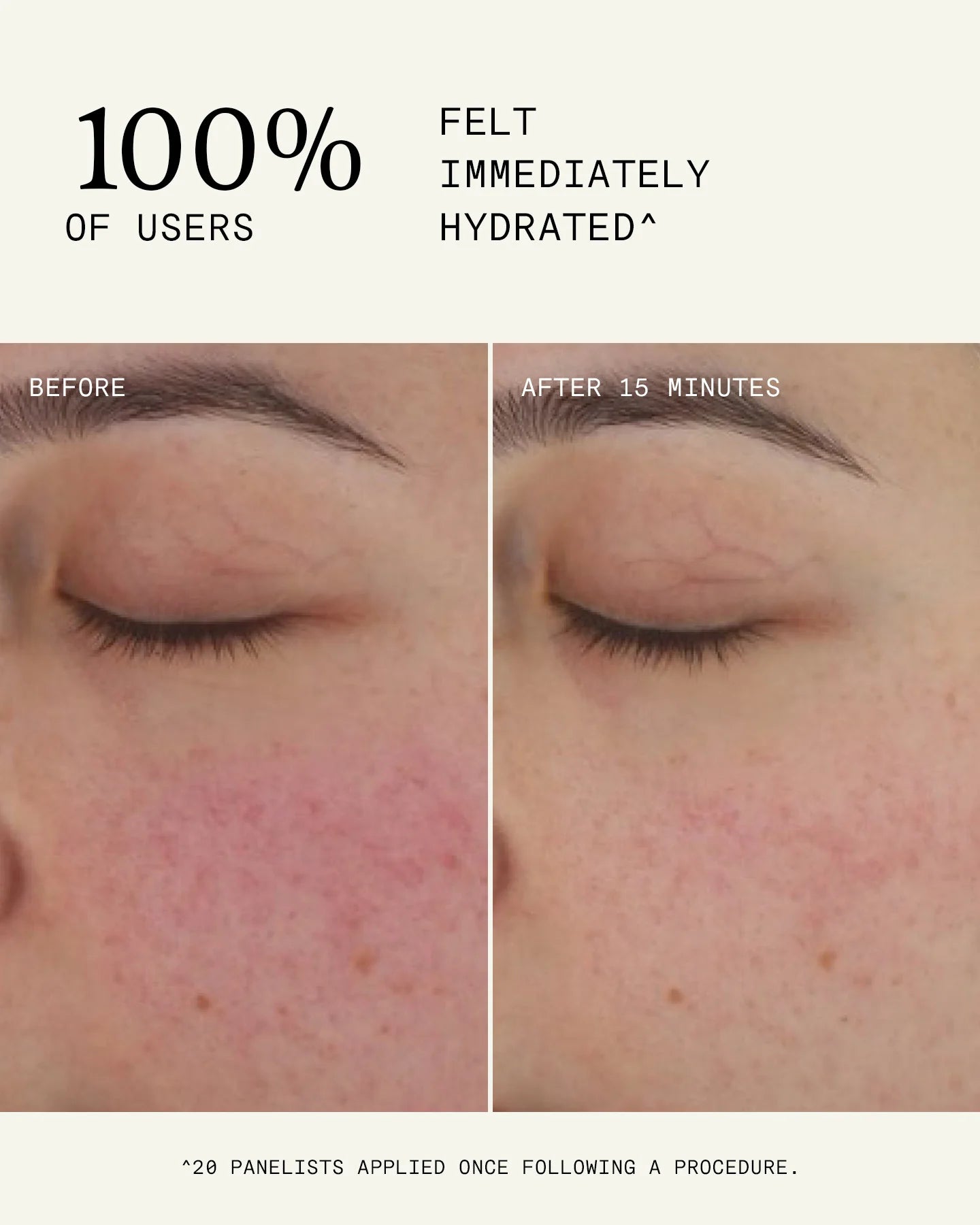 Ultraceuticals Ultra B² Recovery Cream clinically proven hydration and visible redness reduction after post-procedure application.
