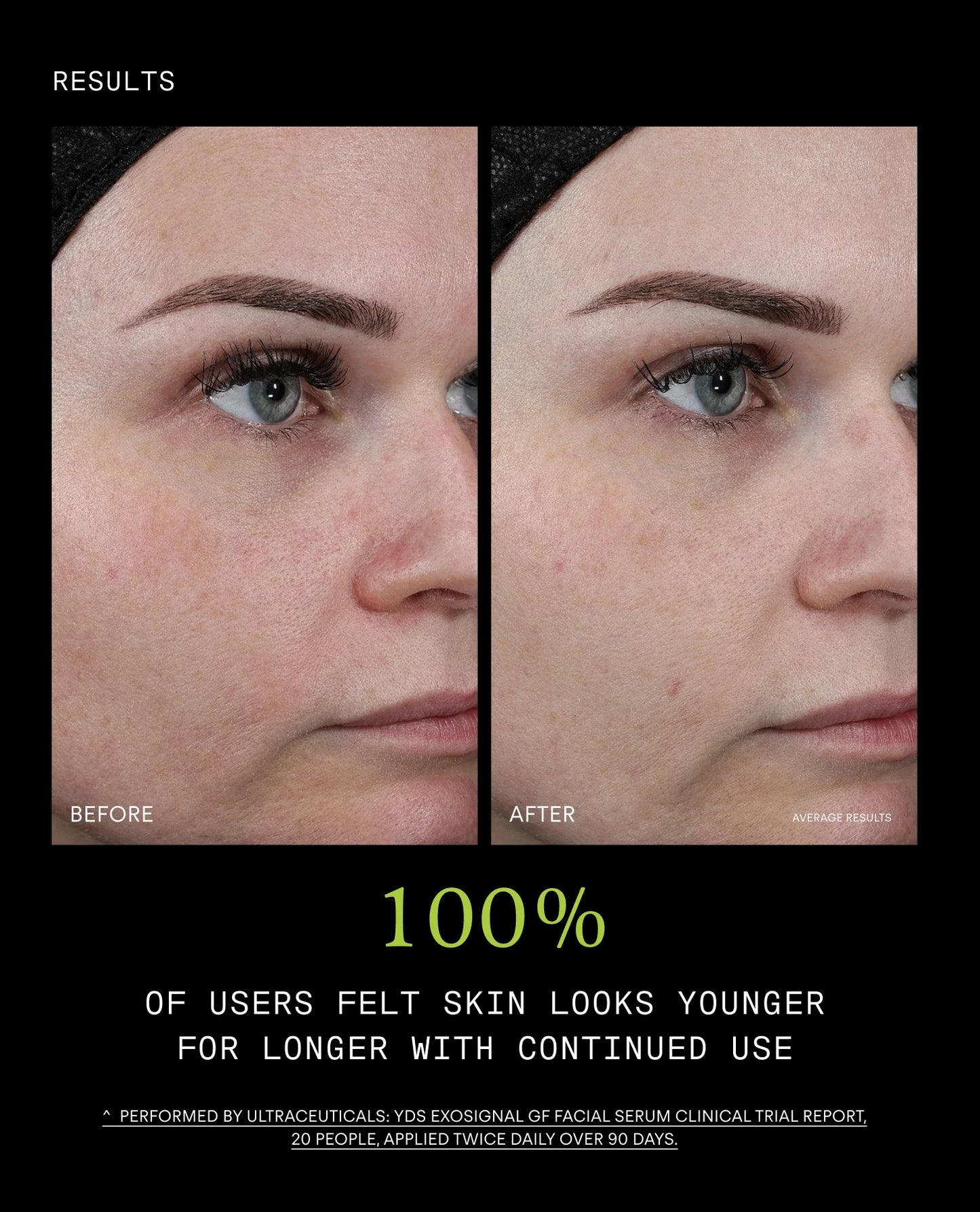 Ultraceuticals Youth Boost ExoSignal GF² Facial Serum clinical results for firmer denser more youthful-looking skin with continued use.