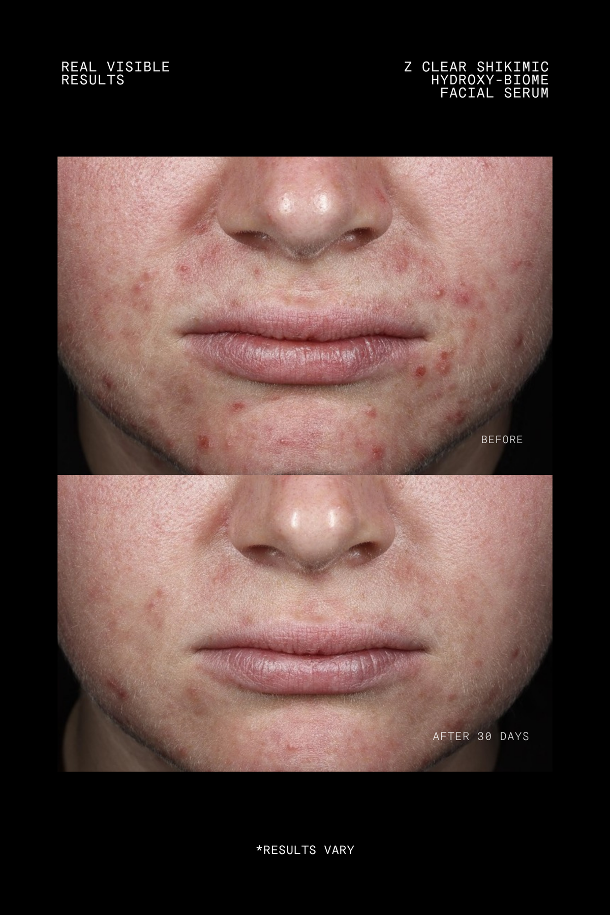 Ultraceuticals Z Clear Shikimic Hydroxy-Biome Facial Serum clinical results after 30 days showing clearer-looking breakout-prone skin.