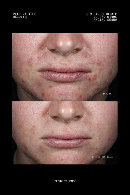Ultraceuticals Z Clear Shikimic Hydroxy-Biome Facial Serum clinical results after 30 days showing clearer-looking breakout-prone skin.
