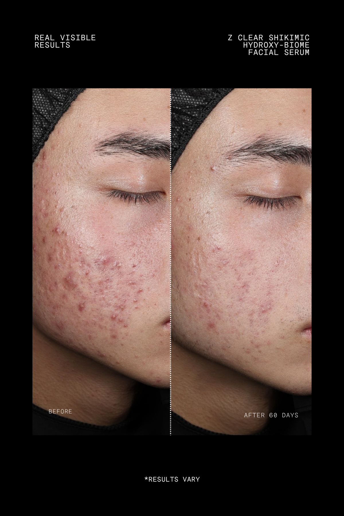 Ultraceuticals Z Clear Shikimic Hydroxy-Biome Facial Serum clinical results after 60 days showing visible reduction in breakouts and congestion.