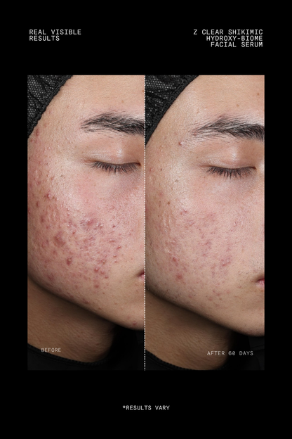 Ultraceuticals Z Clear Shikimic Hydroxy-Biome Facial Serum clinical results after 60 days showing visible reduction in breakouts and congestion.