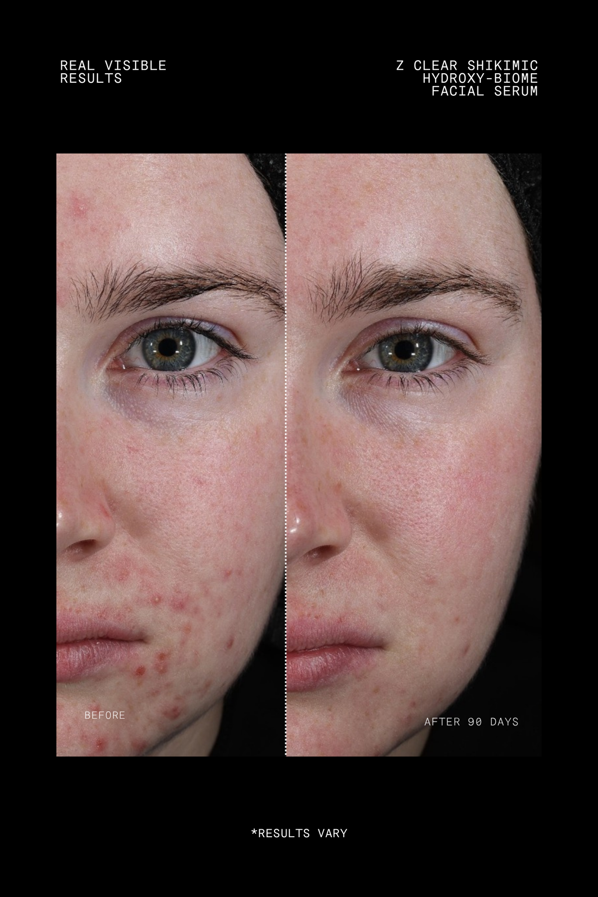 Ultraceuticals Z Clear Shikimic Hydroxy-Biome Facial Serum clinical results after 90 days for improved clarity and healthier-looking skin.