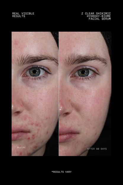 Ultraceuticals Z Clear Shikimic Hydroxy-Biome Facial Serum clinical results after 90 days for improved clarity and healthier-looking skin.