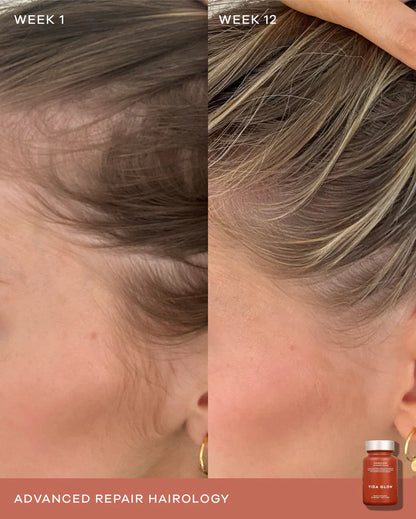 Vida Glow Advanced Repair Hairology hair thinning support for weaker temple areas, reduced shedding and denser healthier-looking strands.