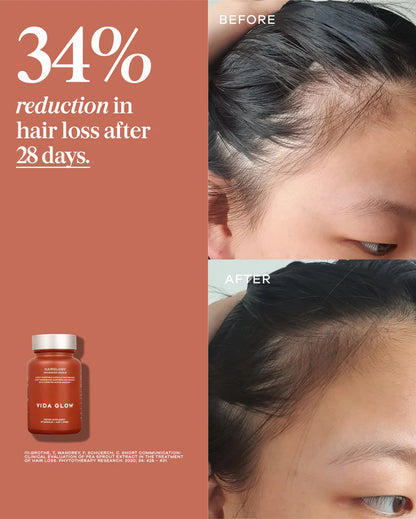 Vida Glow Advanced Repair Hairology before and after results for reduced hair loss, improved hairline fullness and stronger regrowth.