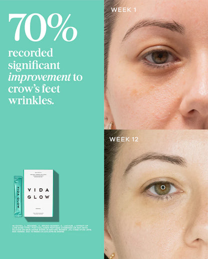 Vida Glow Natural Marine Collagen Pineapple before and after image showing visible improvement in crow’s feet and smoother-looking skin over time.