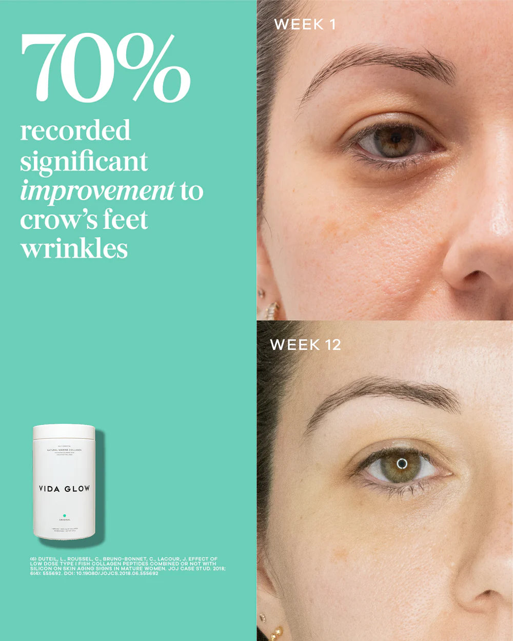 Vida Glow Natural Marine Collagen Powder Glass Tub Original before and after results image showing improvement in crow’s feet appearance and skin smoothness.