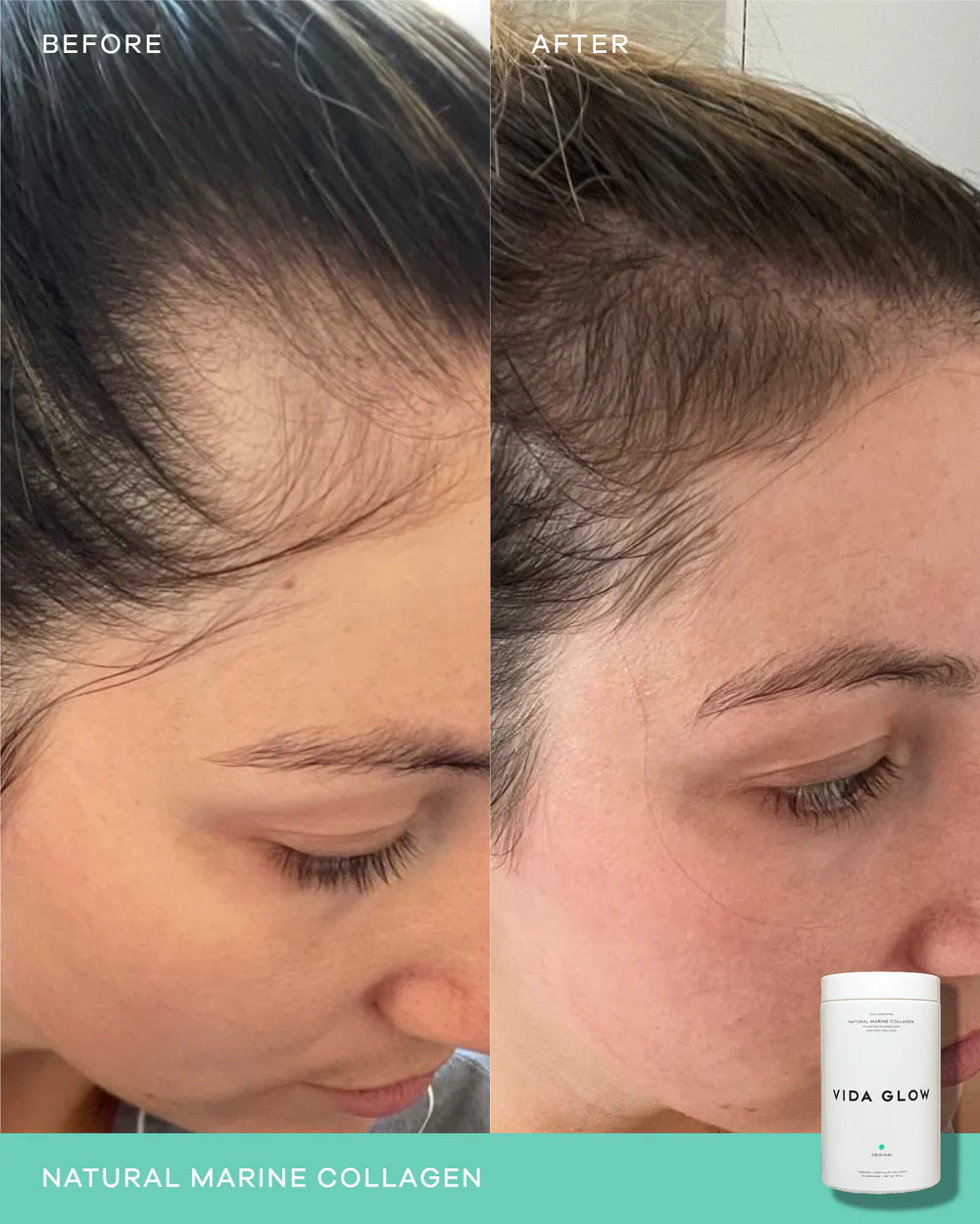 Vida Glow Natural Marine Collagen Powder Glass Tub Original before and after results image showing improved hair density and healthier-looking hair growth with daily marine collagen use.