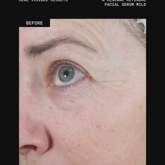 Ultraceuticals A Renewal Retinome Facial Serum Mild retinol treatment for visibly smoother texture, softened fine lines and renewed-looking skin.