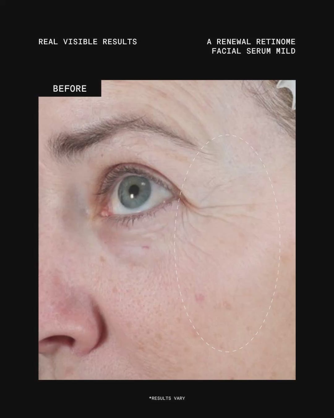 Ultraceuticals A Renewal Retinome Facial Serum Mild retinol treatment for visibly smoother texture, softened fine lines and renewed-looking skin.