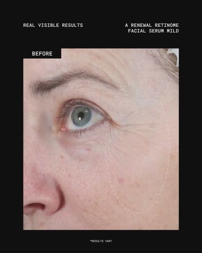 Ultraceuticals A Renewal Retinome Facial Serum Mild retinol treatment for visibly smoother texture, softened fine lines and renewed-looking skin.